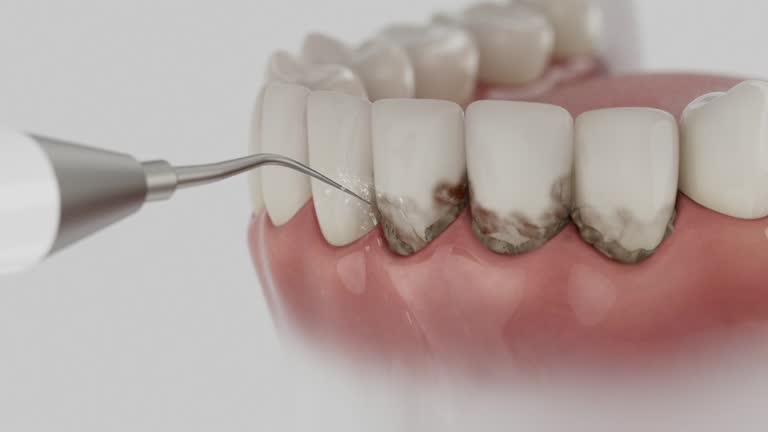 Trusted Wisdom Tooth Removal service in Gustine, CA - Dentist Open Now